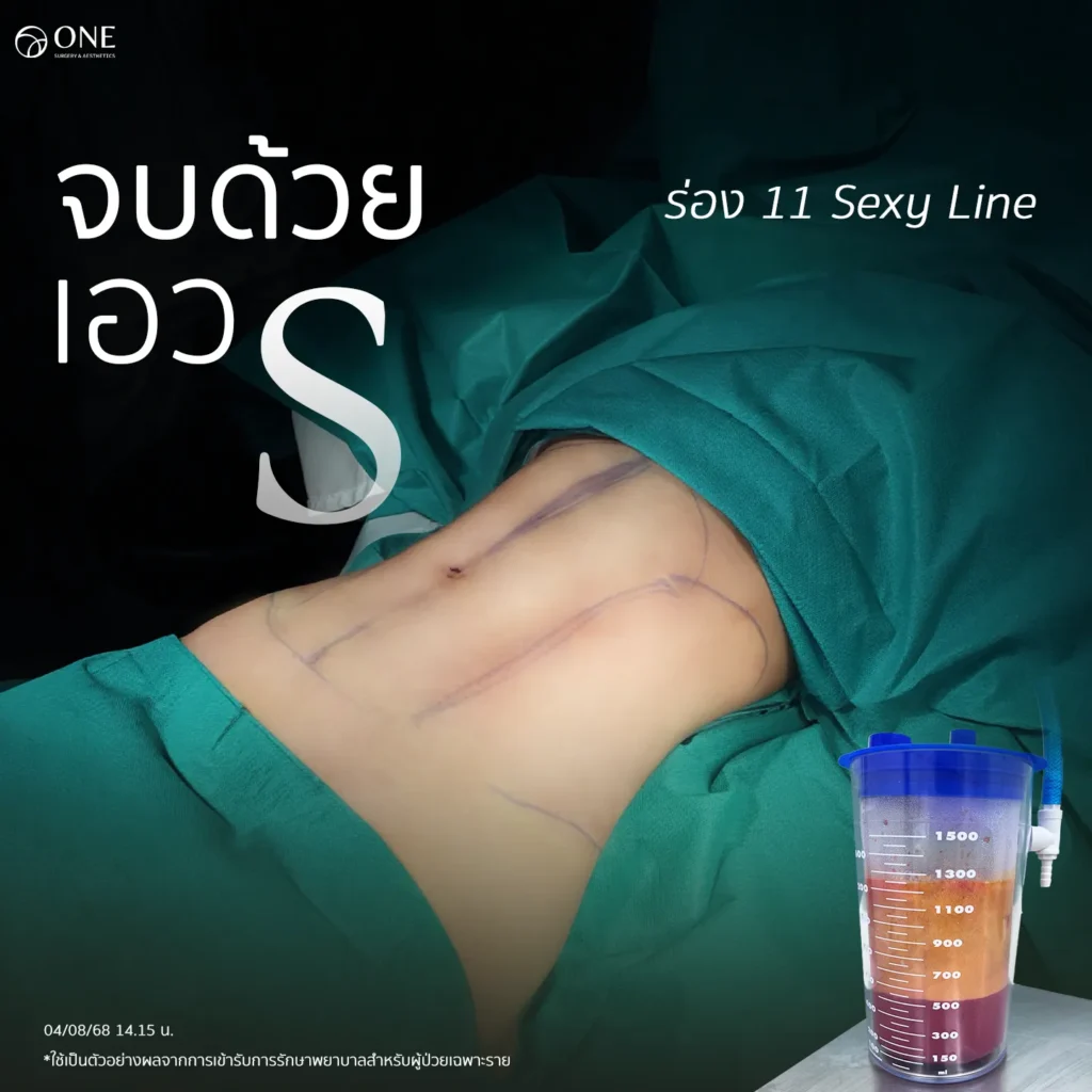 การดูดไขมันคืออะไร