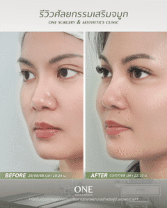 BF-AT คุณฝน_มุม 45 องศา_ด้านซ้าย