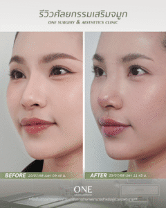 BF-AT คุณมาย_มุม 45 องศา_ด้านซ้าย