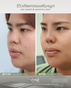 BF-AT คุณมาเบล_มุม 45 องศา_ด้านซ้าย