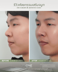 BF-AT คุณเธียร_มุม 45 องศา_ด้านซ้าย