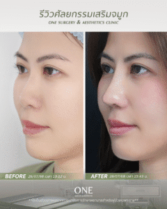 BF-AT คุณแนน_มุม 45 องศา_ด้านซ้าย