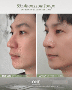 BF-AT คุณแฟ้ม_มุม 45 องศา_ด้านซ้าย (1)