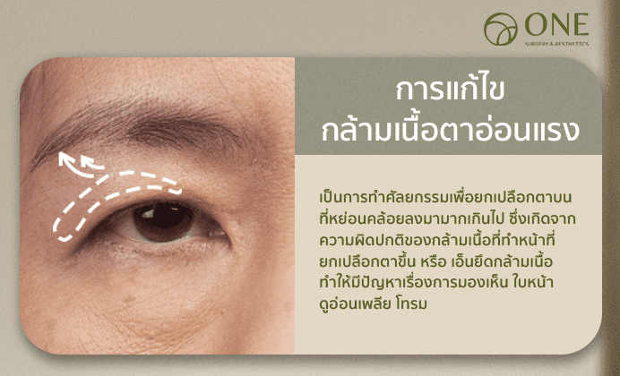 กล้ามเนื้อตาอ่อนแรง