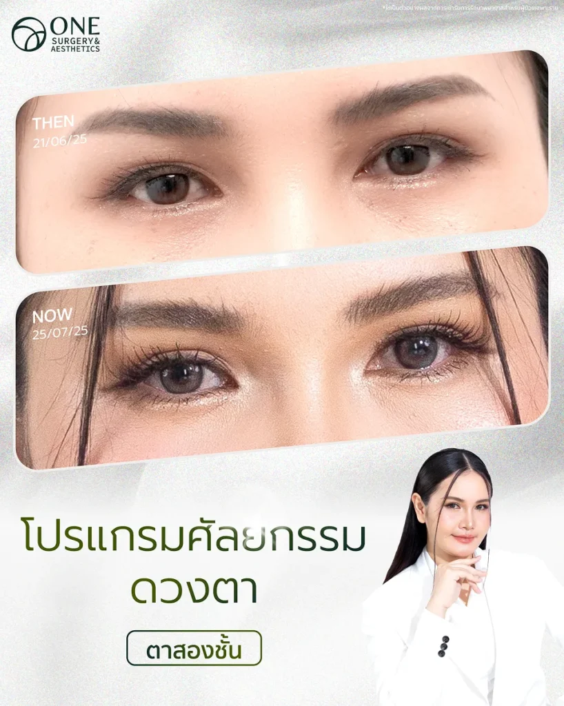 ศัลยกรรมตา