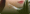 ศัลยกรรมผ่าตัดดึงหน้า (Upper Face)
