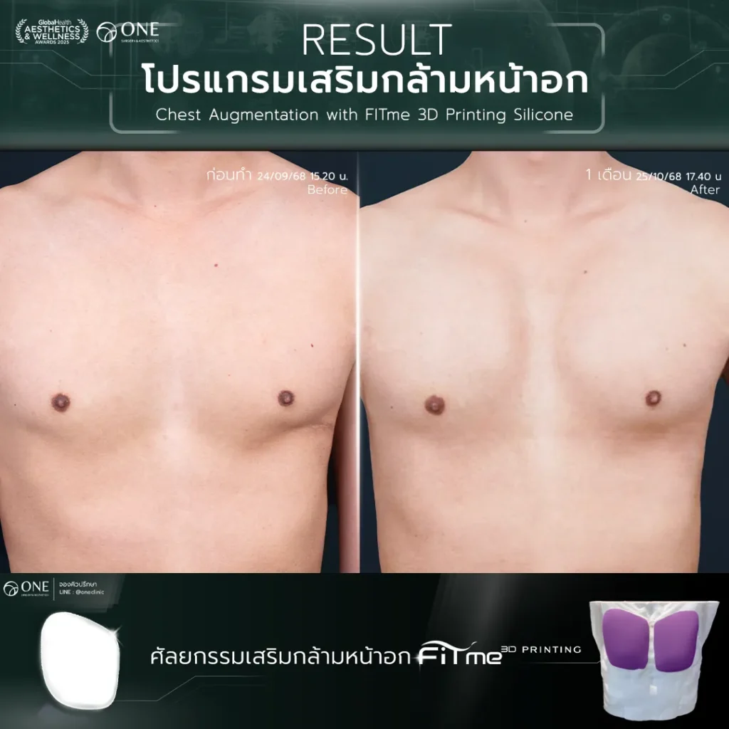 เสริมกล้ามอก 2