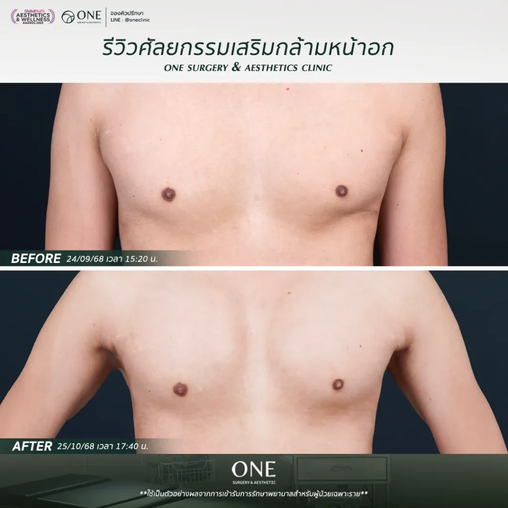 เสริมกล้ามอก 3