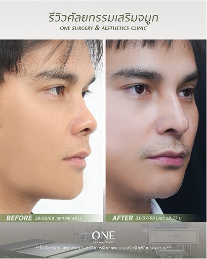 เสริมจมูก