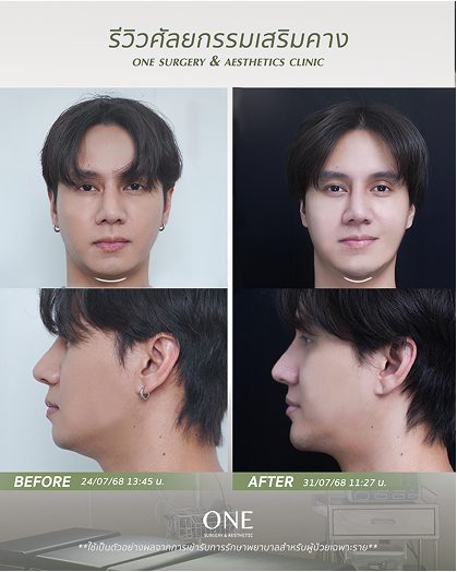 เสริมคาง