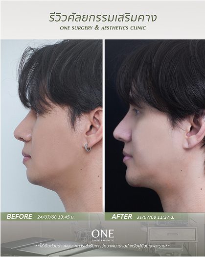 เสริมคาง