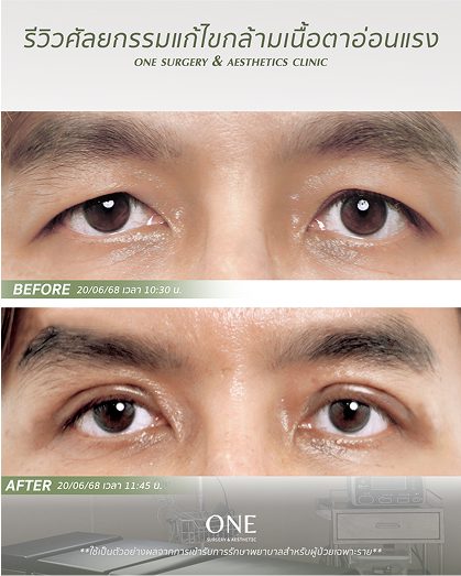 ตาสองชั้นแบบกรีด