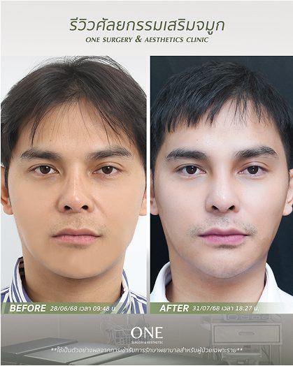 เสริมจมูก