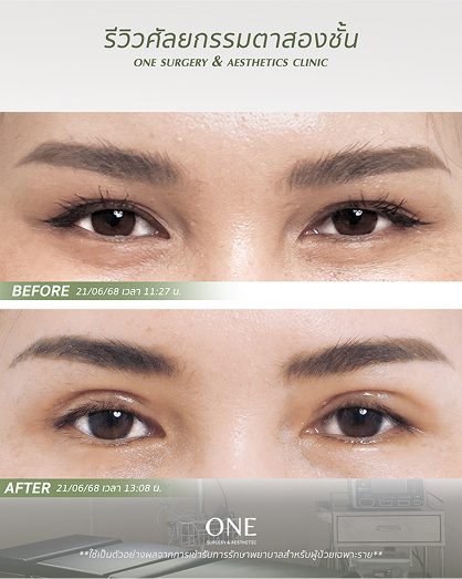 ตาสองชั้นแบบกรีด