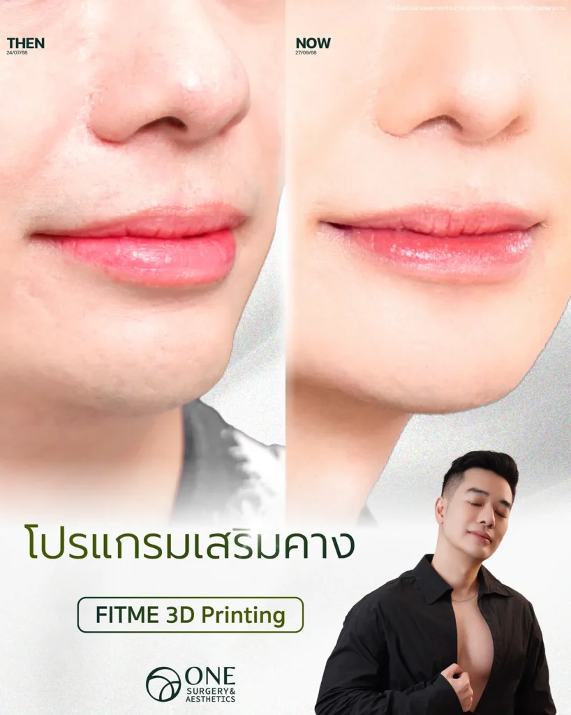 รีวิวเสริมคาง
