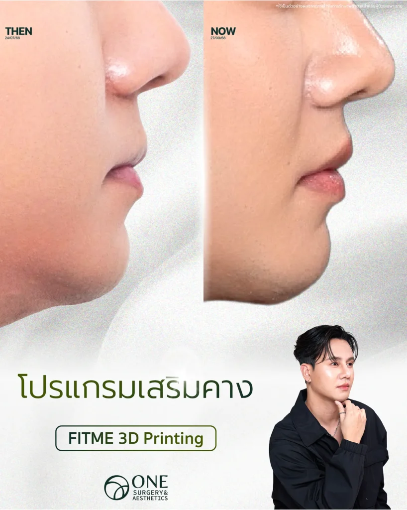 รีวิวเสริมคาง