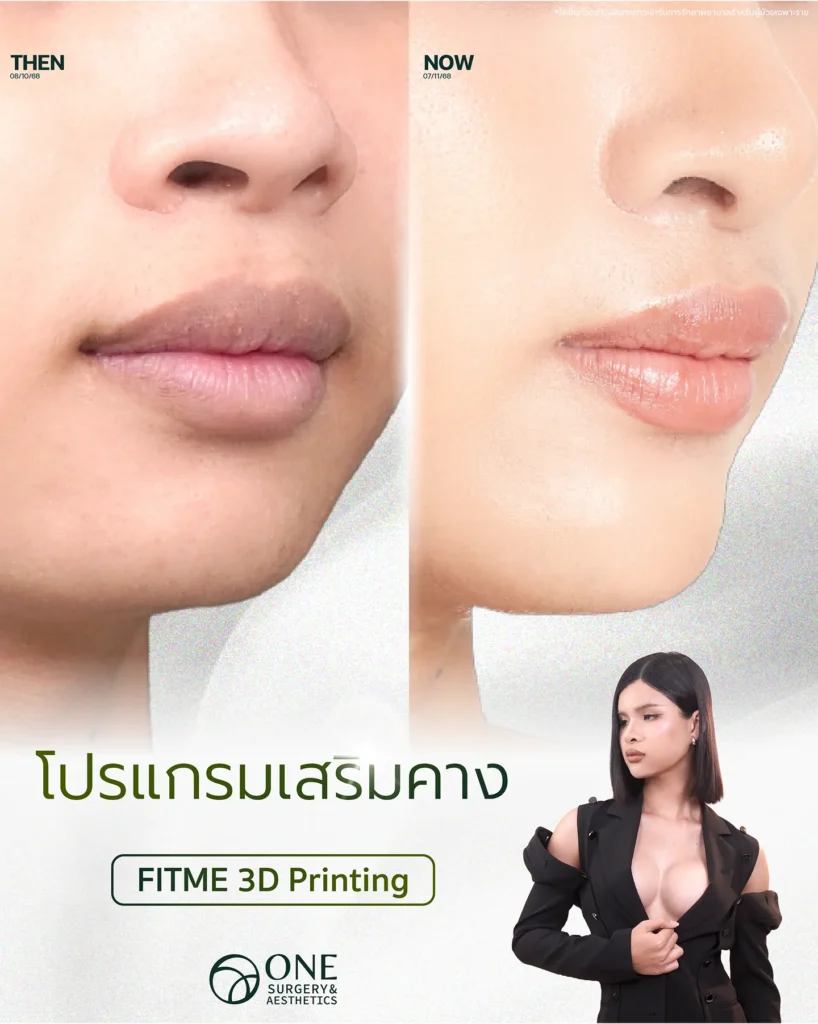 รีวิวเสริมคาง