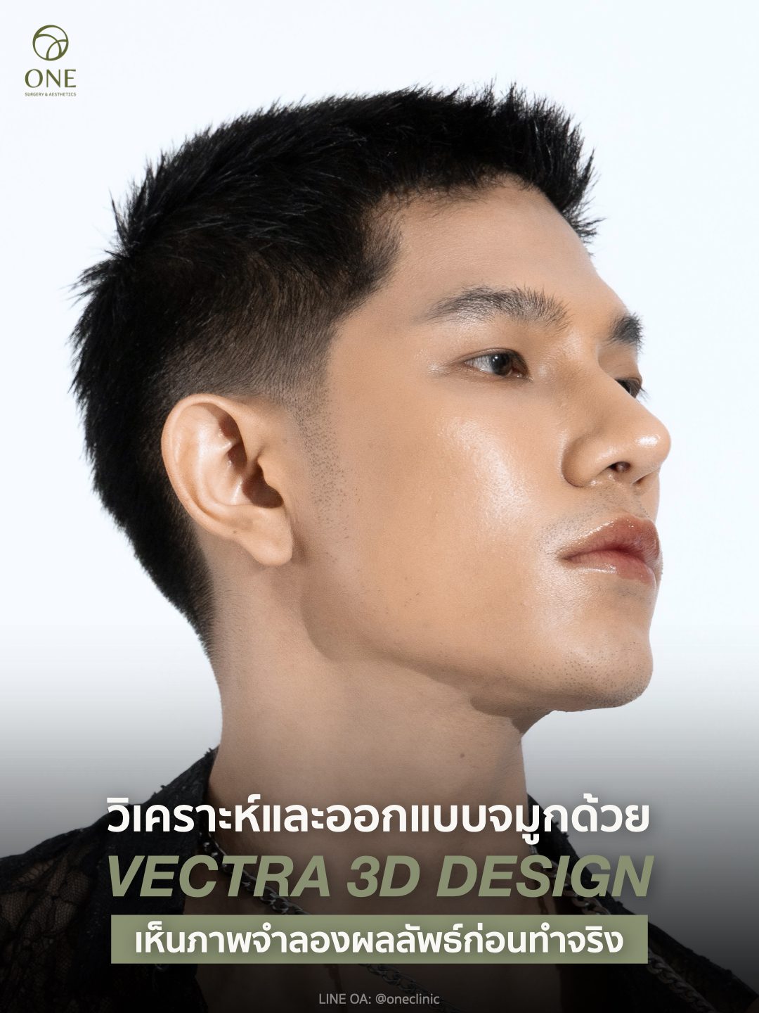 เสริมจมูกโอเพ่น