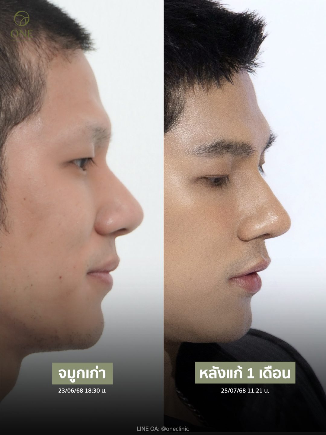 เสริมจมูกโอเพ่น