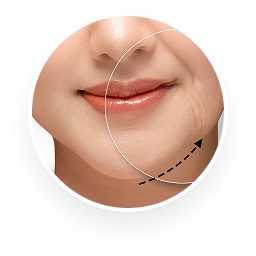 ศัลยกรรมดึงหน้า