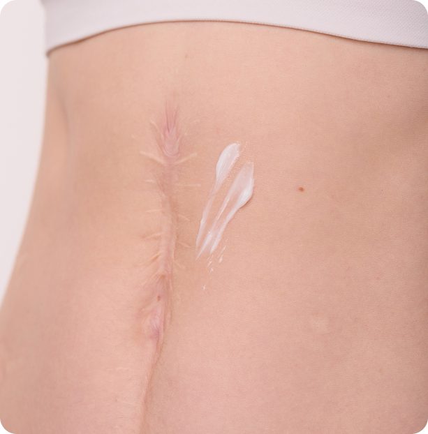 ศัลยกรรมรอยแผลเป็น