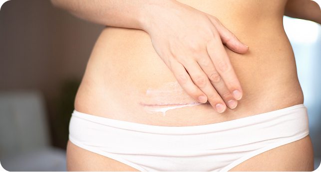 ศัลยกรรมรอยแผลเป็น