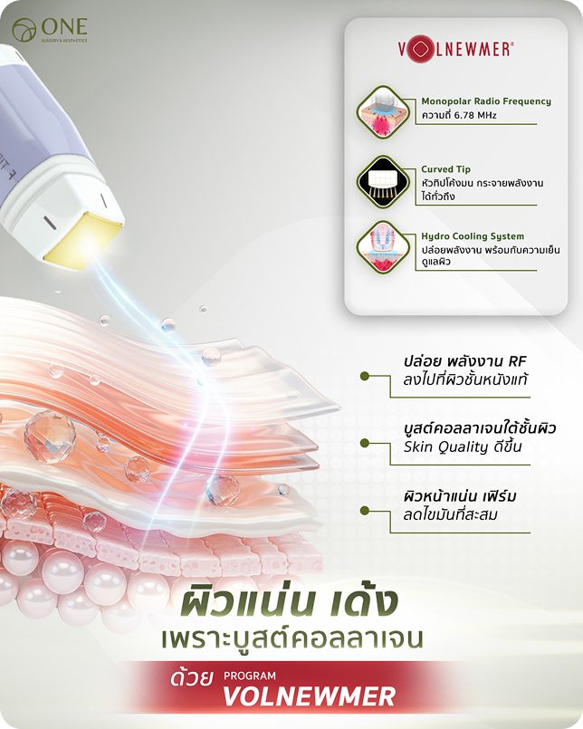 Volnewmer คืออะไร
