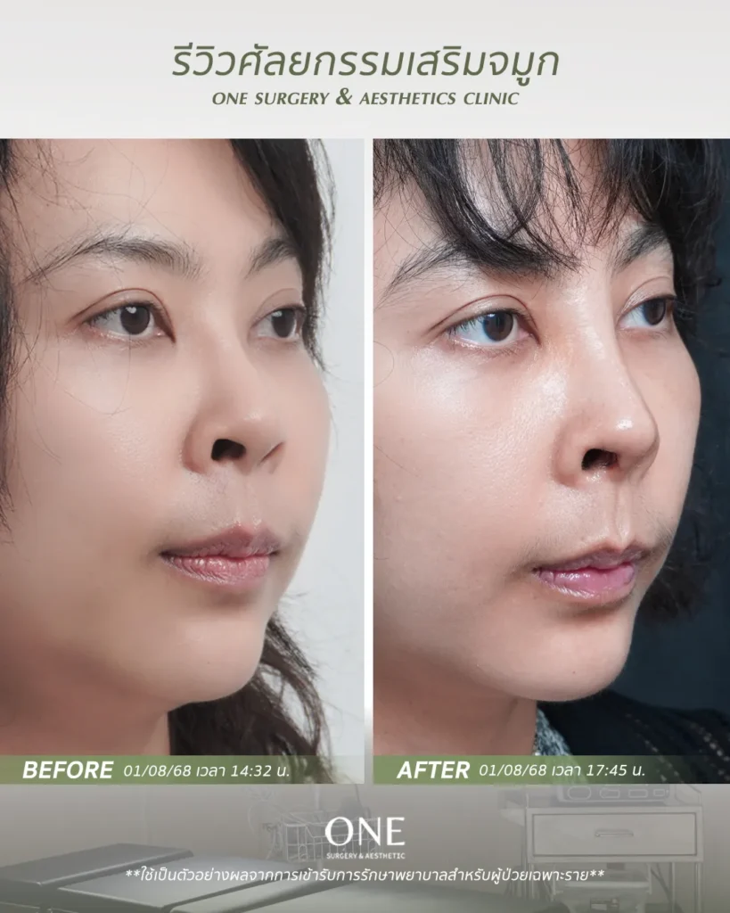 เสริมจมูกโอเพ่น