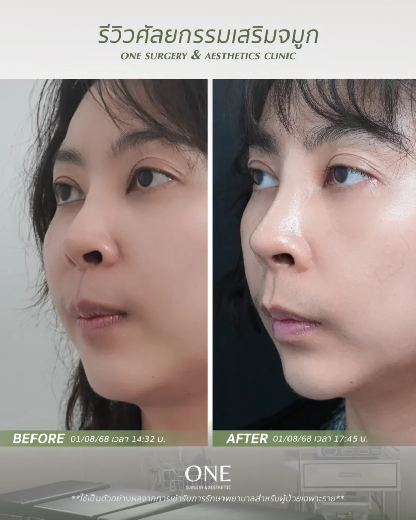 เสริมจมูกโอเพ่น