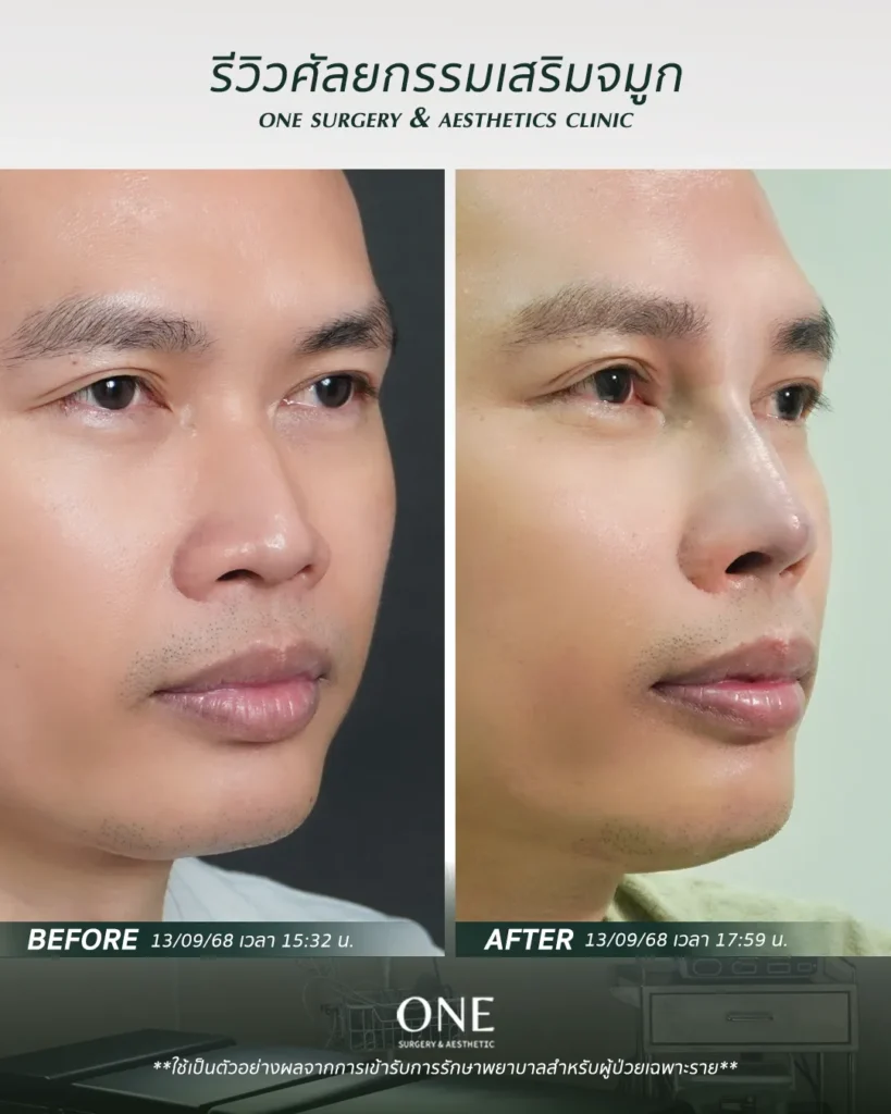 เสริมจมูกโอเพ่น