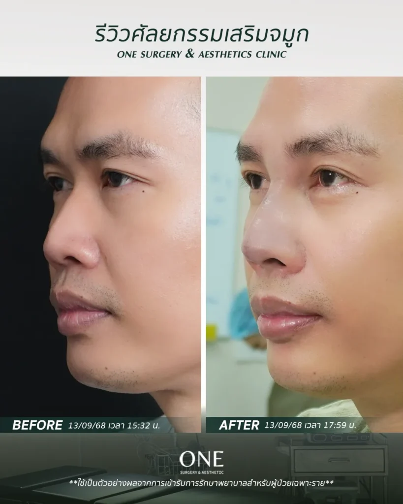 เสริมจมูกโอเพ่น