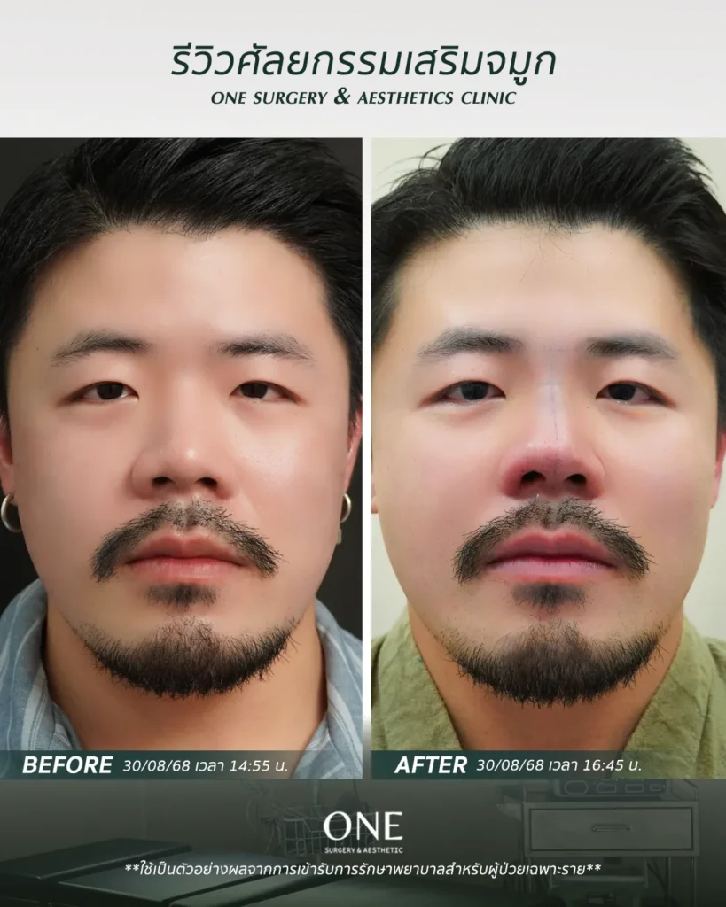 เสริมจมูกโอเพ่น