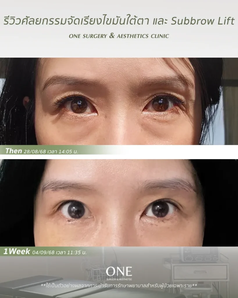 ศัลยกรรมตา