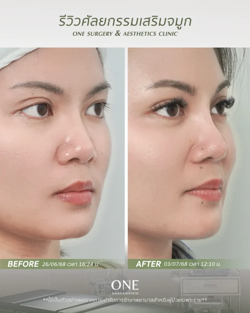 เสริมจมูกโอเพ่น