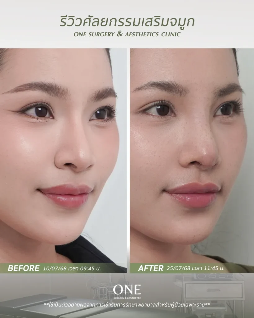 เสริมจมูกโอเพ่น