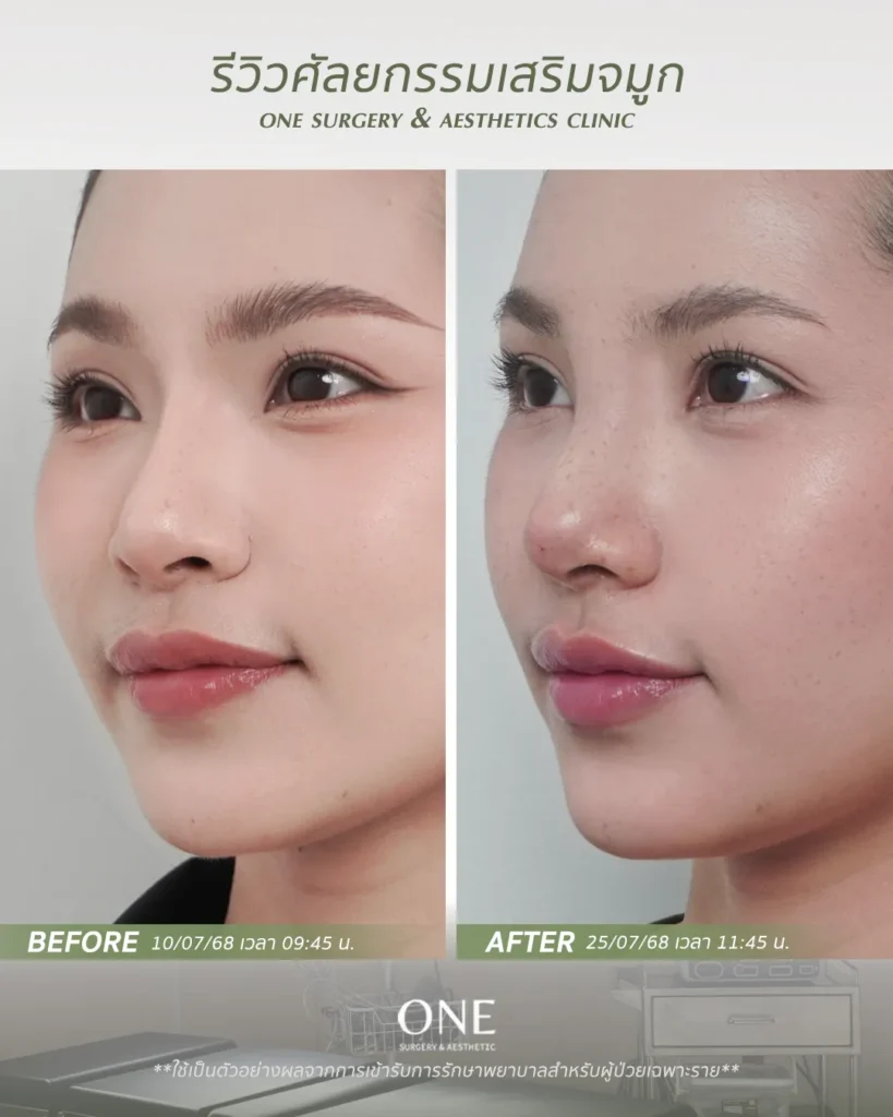 เสริมจมูกโอเพ่น