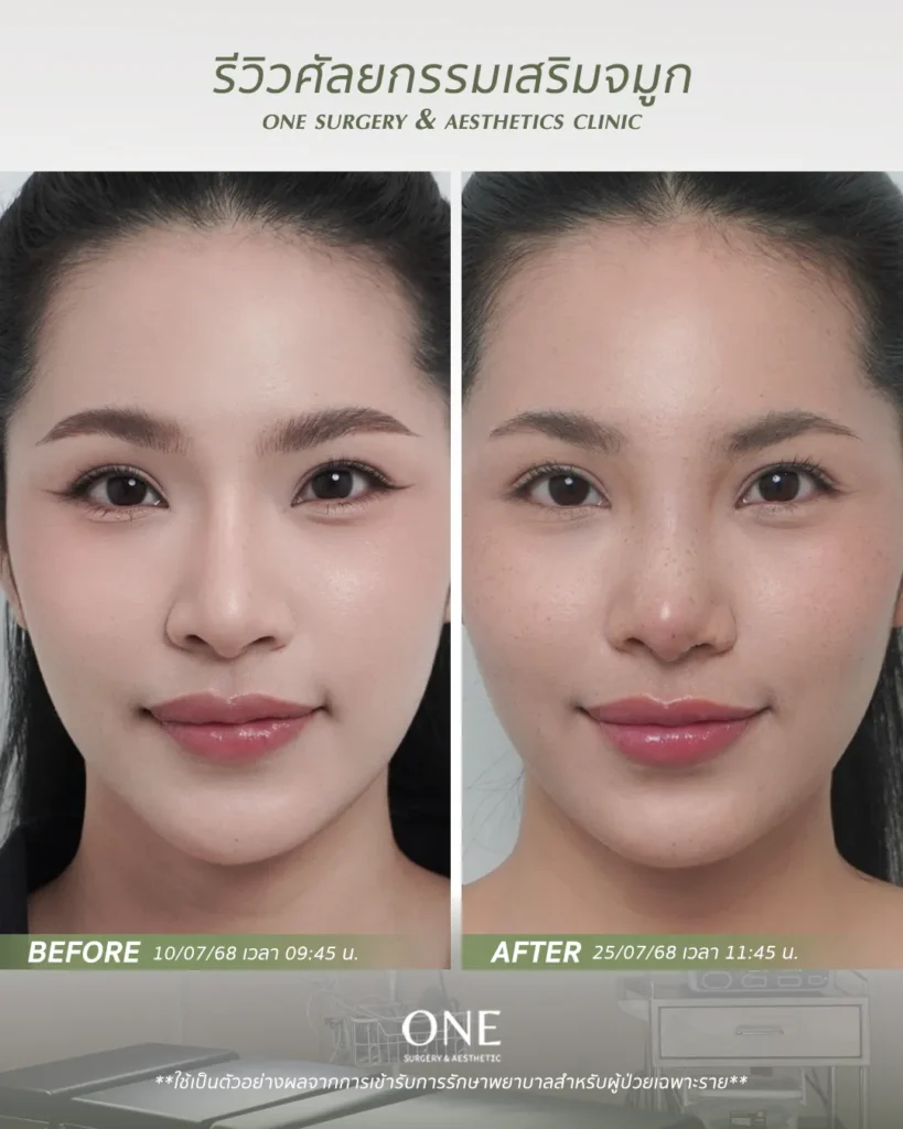 เสริมจมูกโอเพ่น