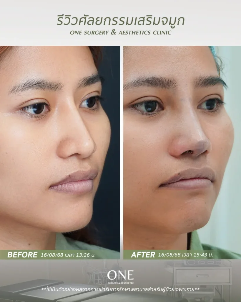 เสริมจมูกโอเพ่น