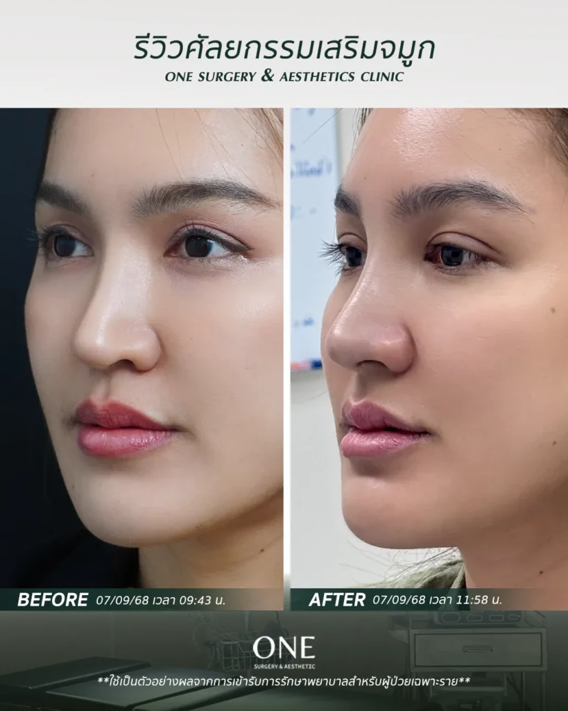เสริมจมูกโอเพ่น