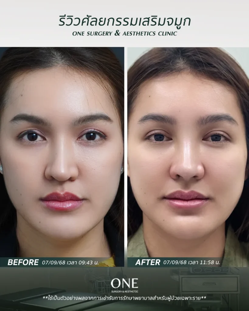 เสริมจมูกโอเพ่น
