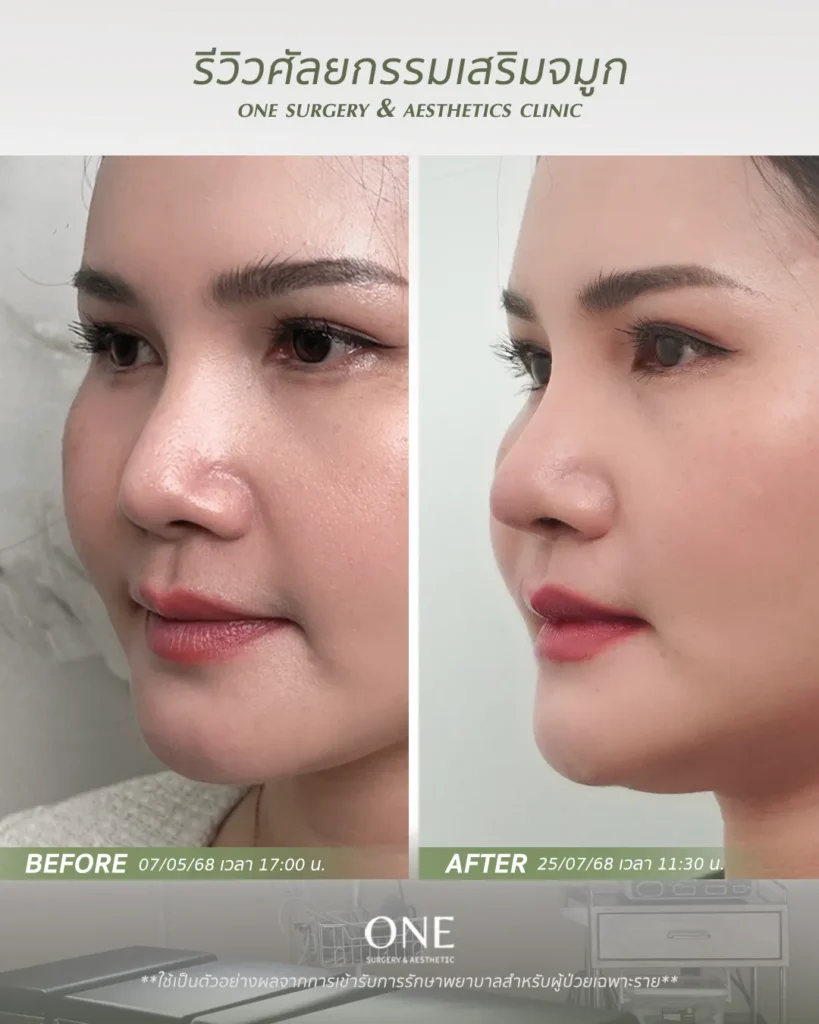 เสริมจมูกโอเพ่น