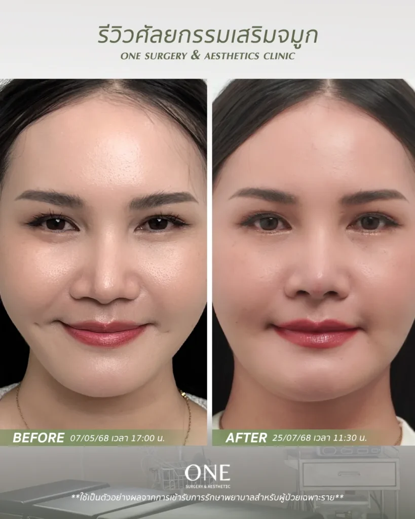 เสริมจมูกโอเพ่น