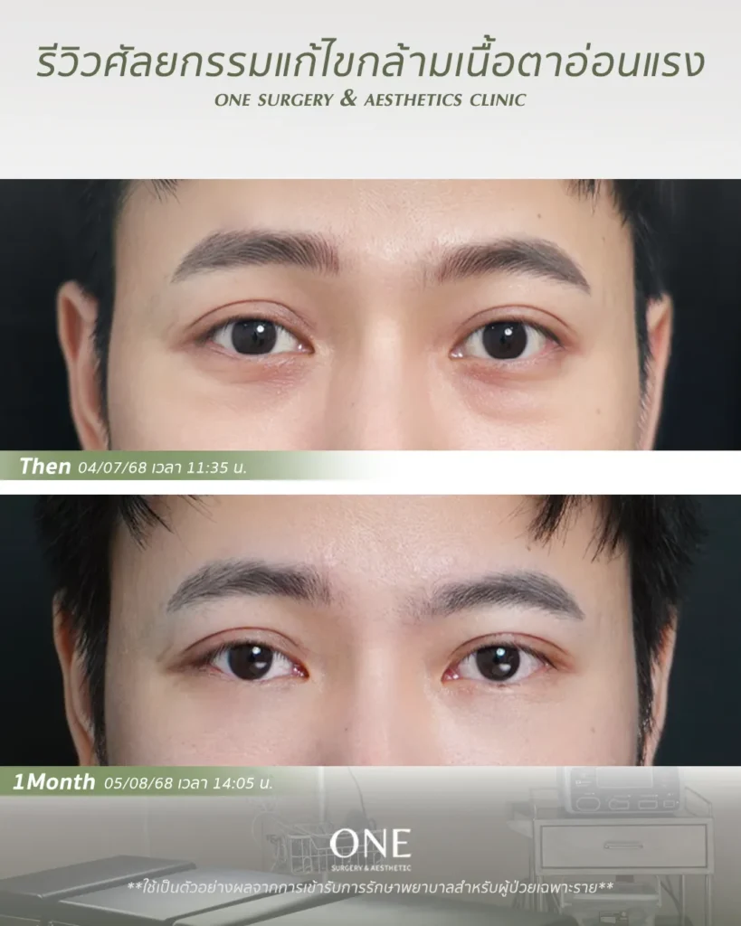 ศัลยกรรมตา