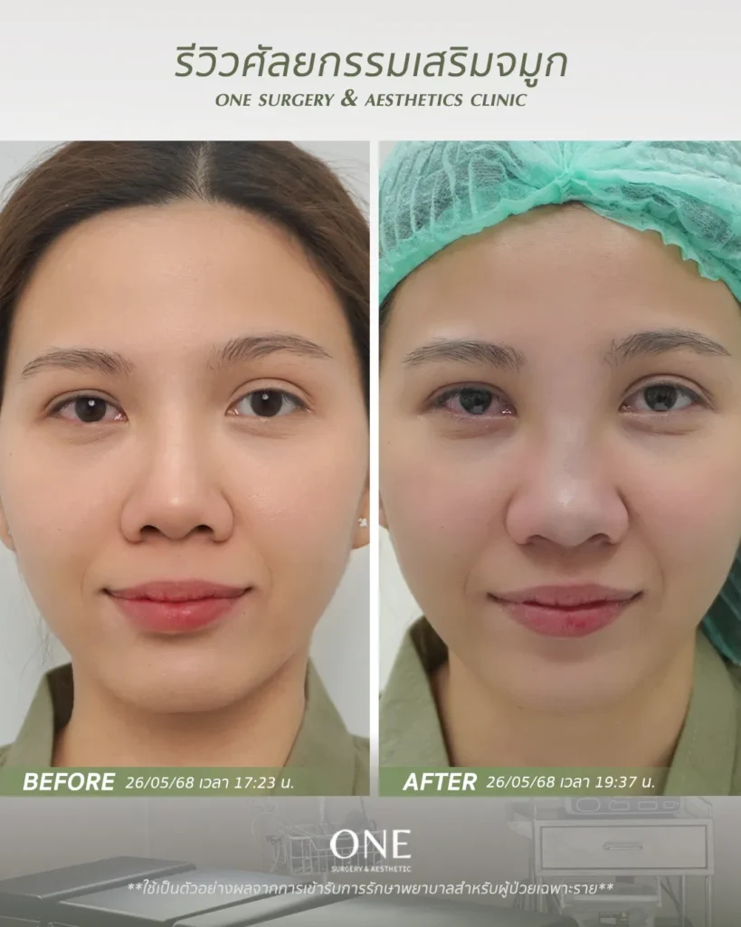 เสริมจมูกโอเพ่น