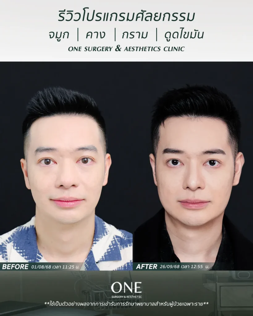 ศัลยกรรมคาง