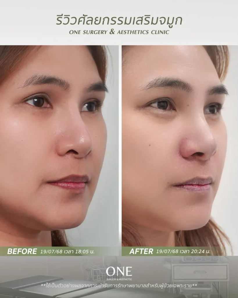 เสริมจมูกโอเพ่น