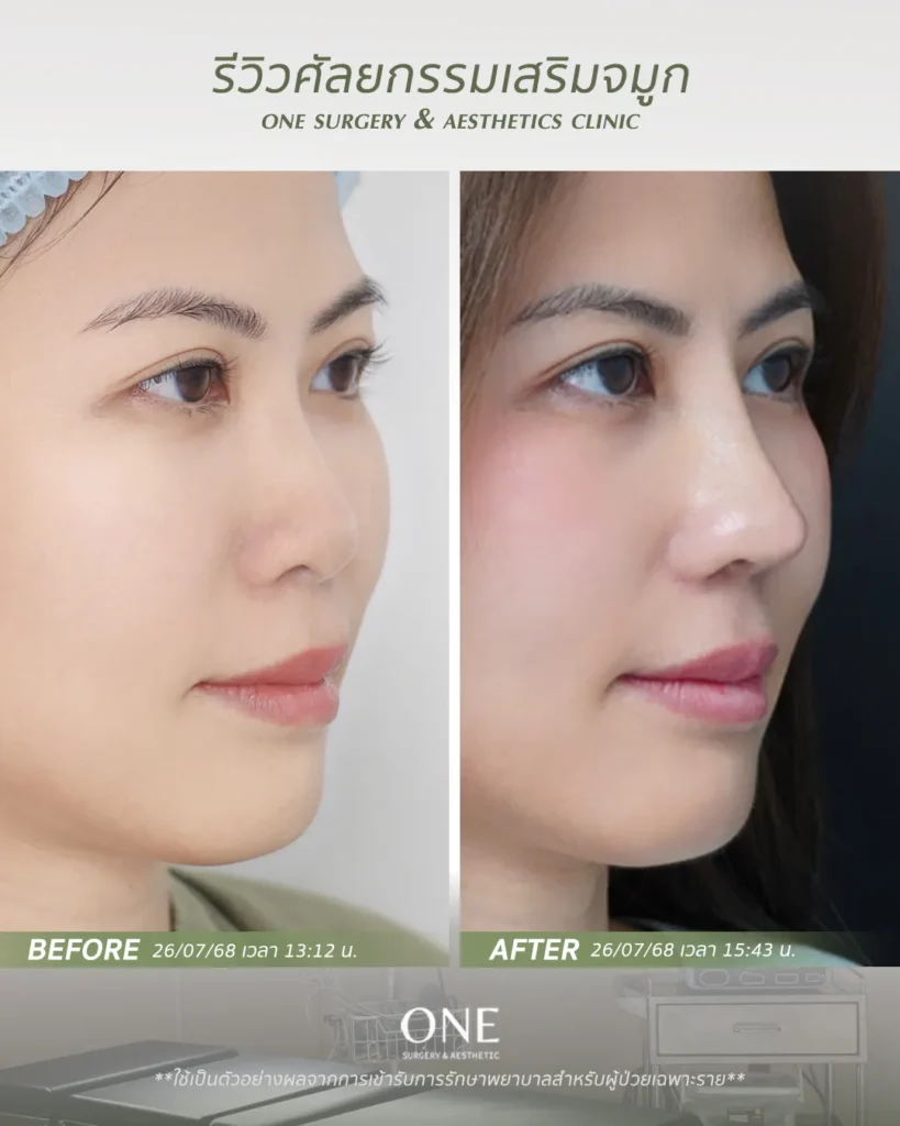 เสริมจมูกโอเพ่น
