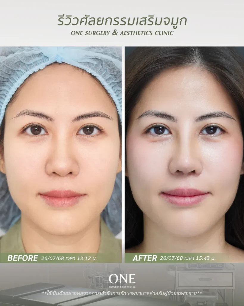 เสริมจมูกโอเพ่น