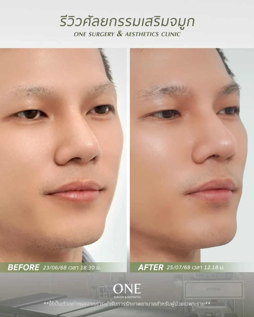 เสริมจมูกโอเพ่น