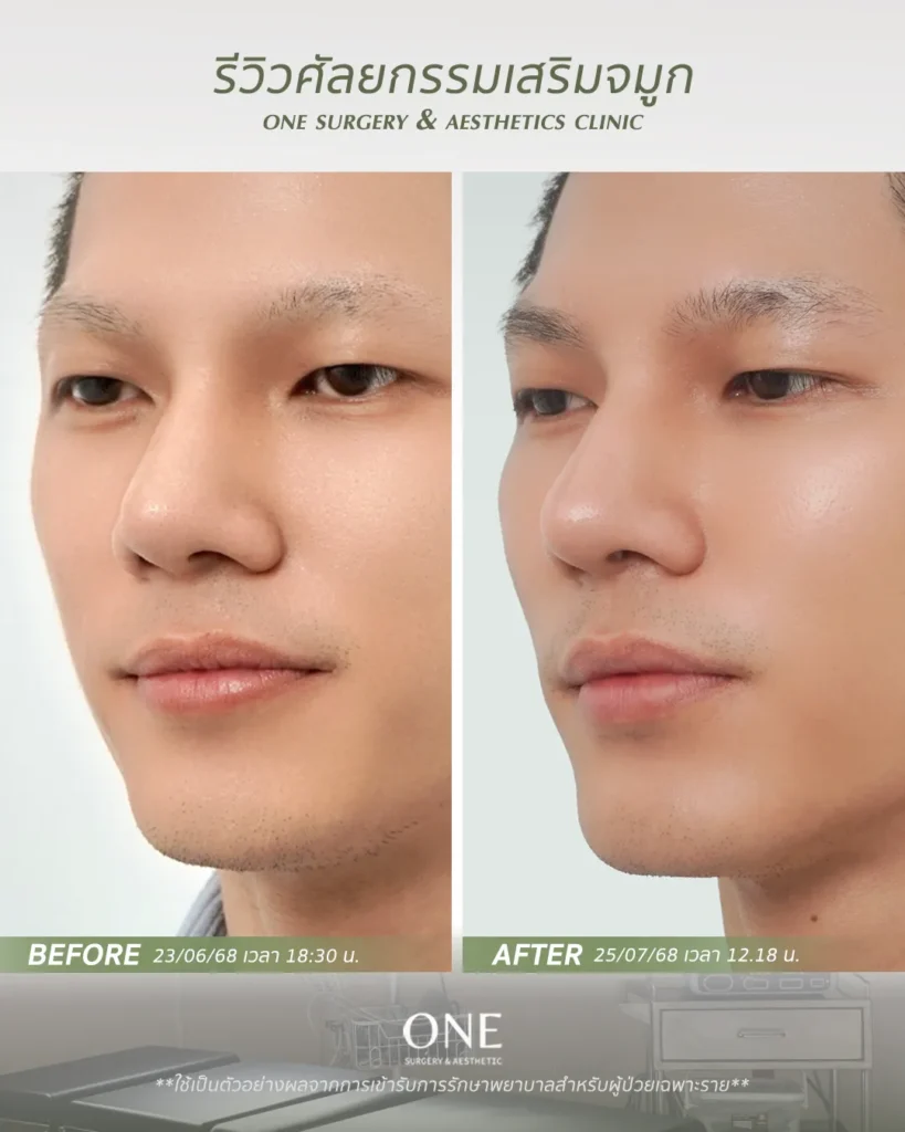 เสริมจมูกโอเพ่น